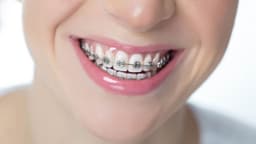 Mất răng số 5 có niềng được không?