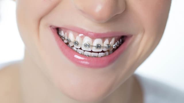 Mất răng số 5 có niềng được không?