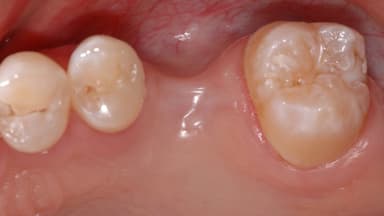 Mất răng số 6 hàm trên và dưới có sao không?