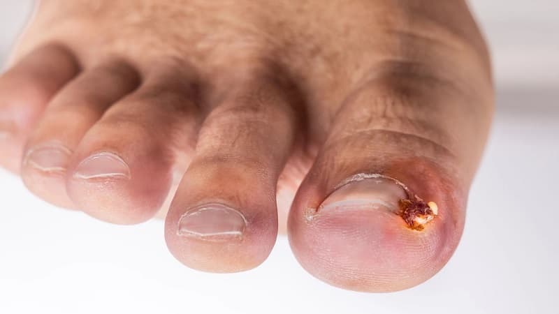 móng chân mọc ngược