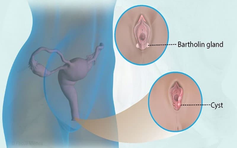 áp xe viêm tuyến bartholin có tự khỏi