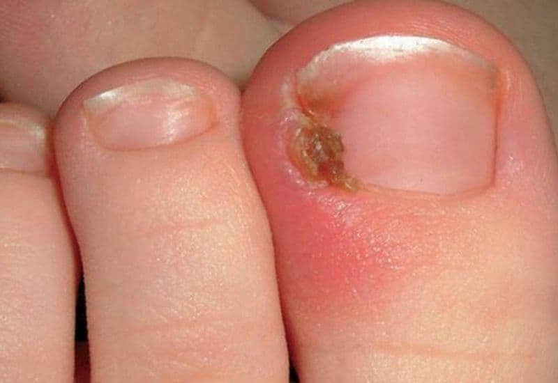 móng chọc thịt sau sinh