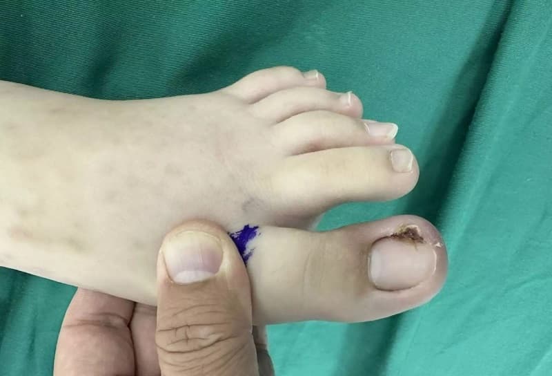 cách chữa móng chân bị quặp