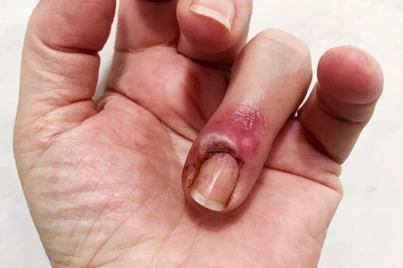 mụn mủ ở ngón chân cái