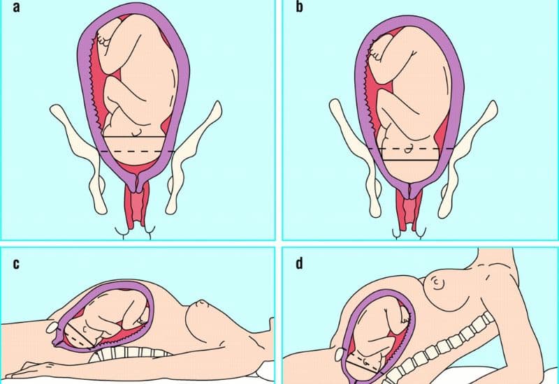 ngôi thai chưa cố định là gì