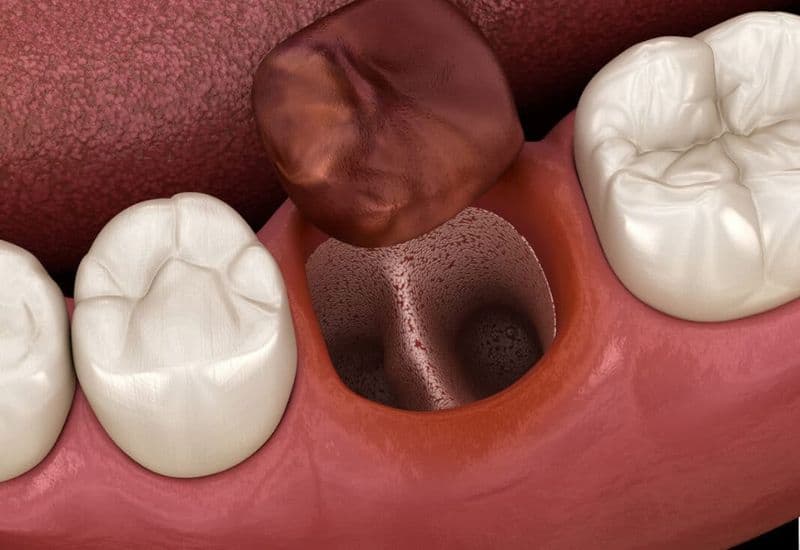 nhổ răng khôn mất bao lâu để hồi phục