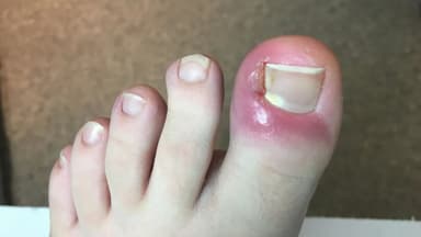 Nổi mụn mủ ở ngón chân, tay: Mối nguy khi tự xử trí