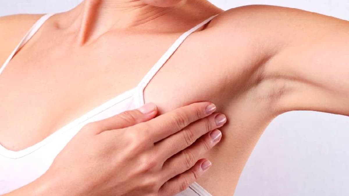 Phác đồ điều trị áp xe vú Bộ Y tế