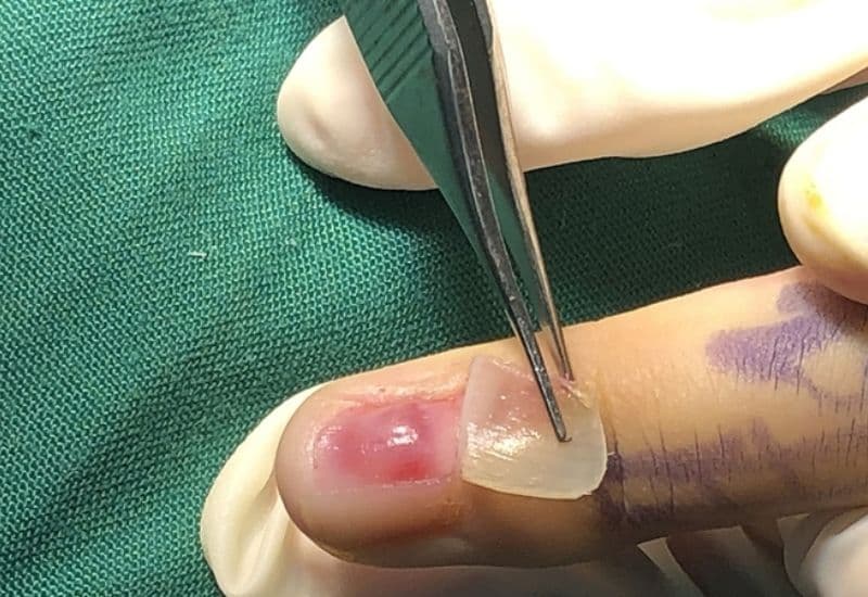 phẫu thuật u cuộn mạch dưới móng