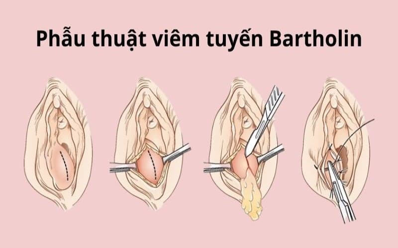 áp xe viêm tuyến bartholin có tự khỏi