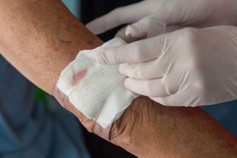 quy trình kỹ thuật chích rạch áp xe nhỏ