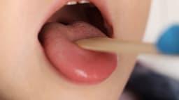 Quy trình kỹ thuật cắt u lưỡi lành tính