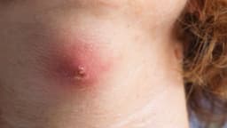 Tìm hiểu quy trình kỹ thuật chích rạch áp xe nhỏ