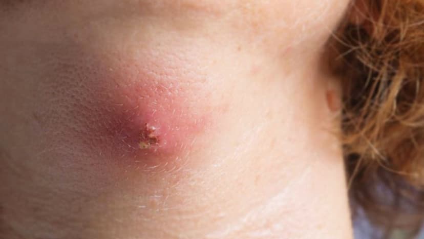 Tìm hiểu quy trình kỹ thuật chích rạch áp xe nhỏ