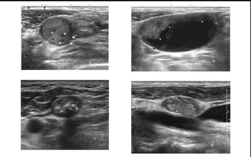 hình ảnh siêu âm hạch lành tính