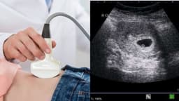 Thai 1-2 tuần siêu âm đầu dò có thấy không?