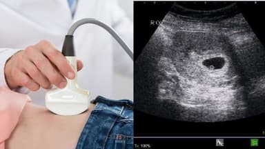 Thai 1-2 tuần siêu âm đầu dò có thấy không?