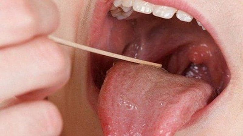 áp xe amidan uống thuốc gì