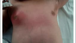 Nguyên nhân áp xe vú ở trẻ sơ sinh