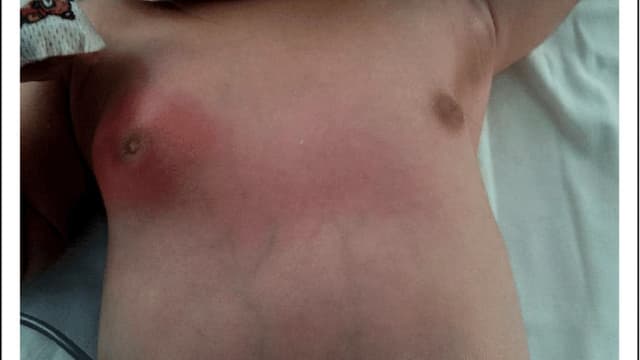 Nguyên nhân áp xe vú ở trẻ sơ sinh