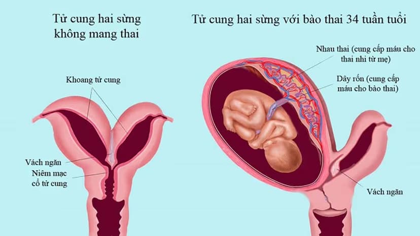 Tử cung 2 sừng có làm IVF được không