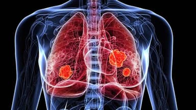 Tỷ lệ u phổi lành tính và ác tính, sự khác biệt của chúng là gì?