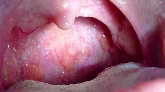 U nhú amidan lành tính có nguy hiểm? Có nên cắt?