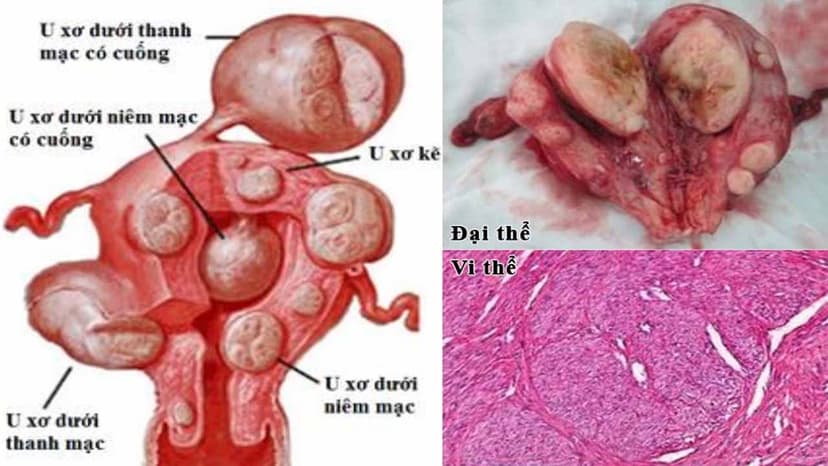 U cơ trơn tử cung có nguy hiểm không?