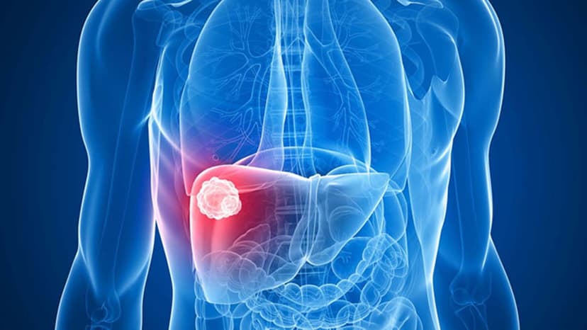 Bị u gan lành tính nên ăn gì? Nên kiêng gì?