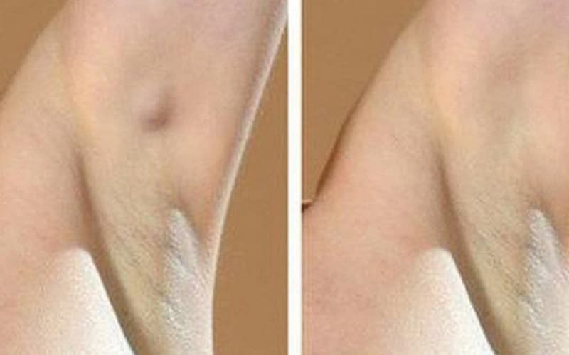 u lành hạch lympho