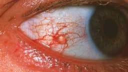 U kết mạc có nguy hiểm không?