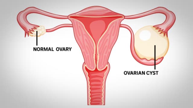 U lành buồng trứng là gì? Dấu hiệu u nang buồng trứng lành tính