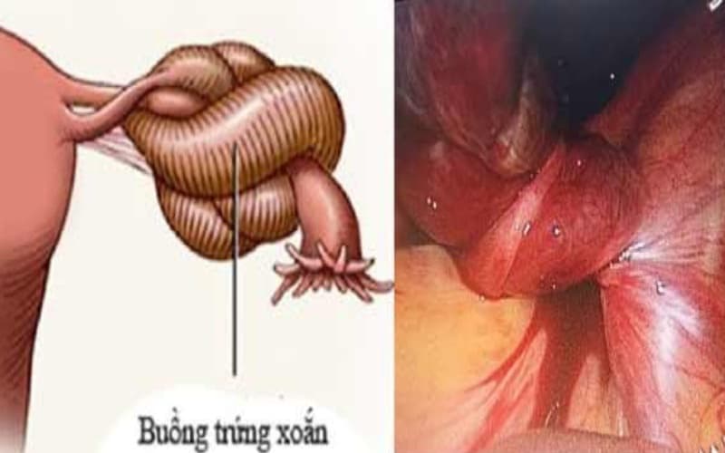 u lành buồng trứng là gì