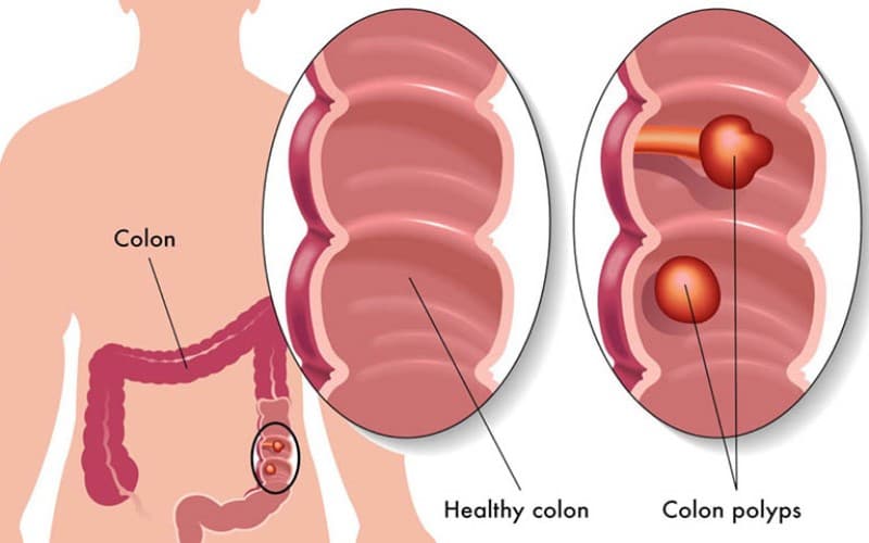u đại tràng có lành tính không