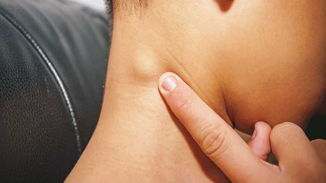 U lành hạch lympho là gì? Nó có nguy hiểm?