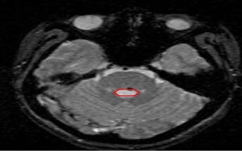 u lành mạch máu dạng hang