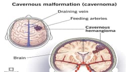 U lành mạch máu dạng hang có nguy hiểm?
