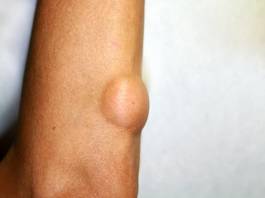 Khối u lành tính có nên mổ không?