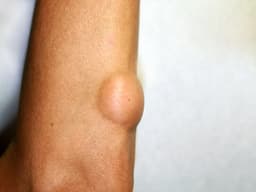 Khối u lành tính có nên mổ không?