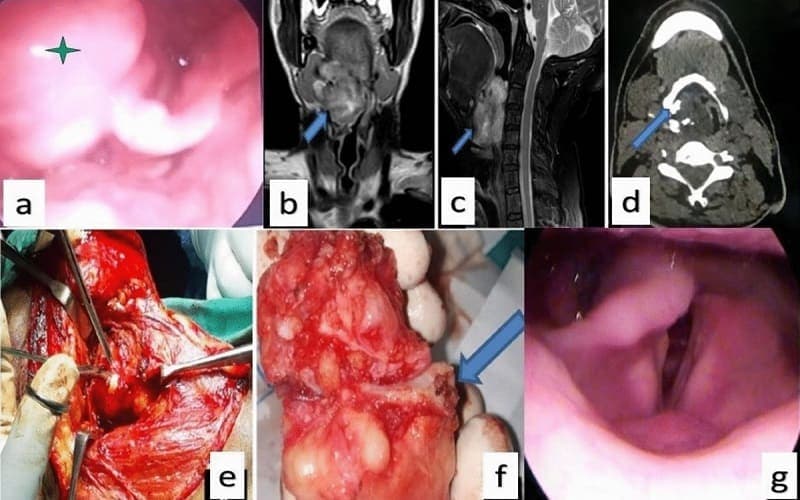 u thanh quản lành tính