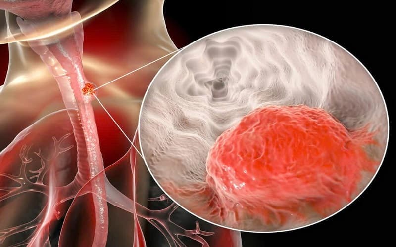 u thực quản lành tính và ác tính