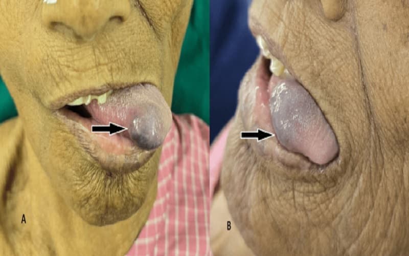 u lành mạch máu dạng hang