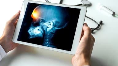 U màng não lành tính sống được bao lâu?