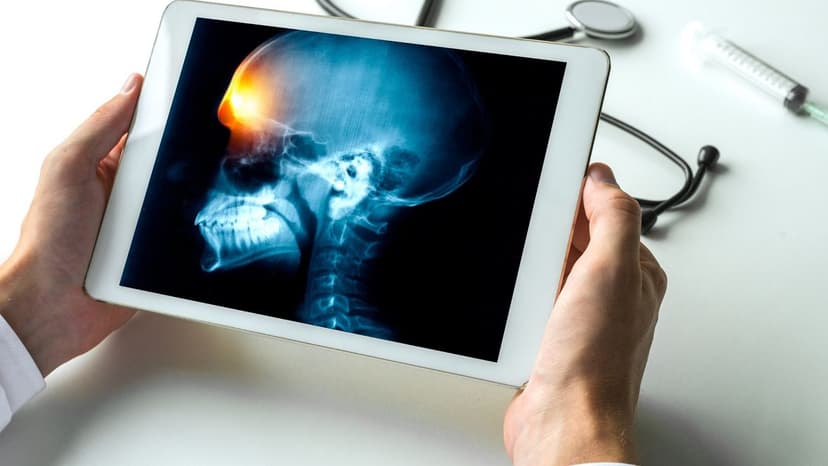 U màng não lành tính sống được bao lâu?