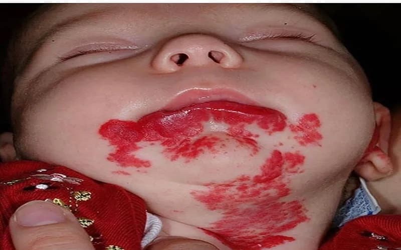 u máu lành tính trẻ em