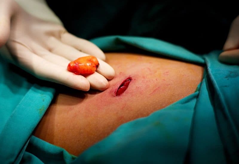 mổ u mỡ bao lâu lành