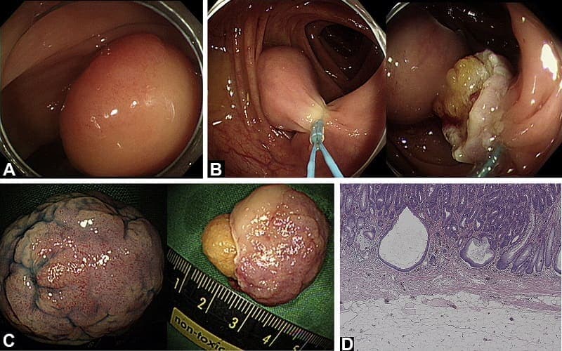 u mỡ đại tràng