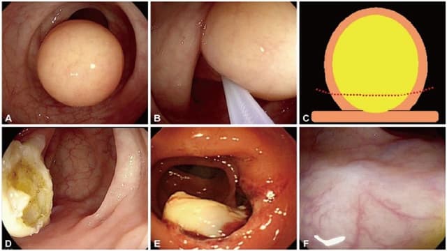 U mỡ đại tràng có nguy hiểm không?