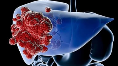 U mỡ ở gan có nguy hiểm không?