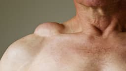 U mỡ là gì? Nguyên nhân, dấu hiệu, các loại thường gặp